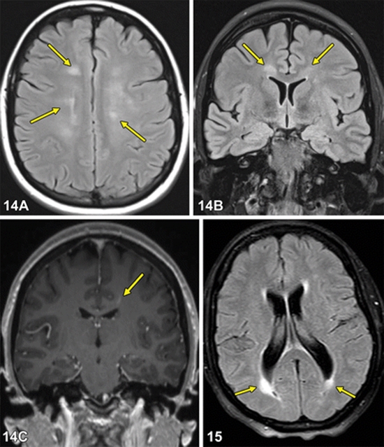 Systemic Lupus Erythematosus With Or Without Neurological Manifestations {faces}